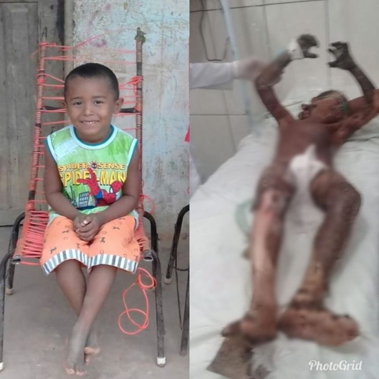 Pai também sofreu lesões ao salvar filho queimado em carvoaria